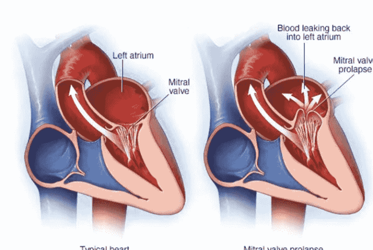 Heart Disease? Mitral Valve Disease and Heart Failure